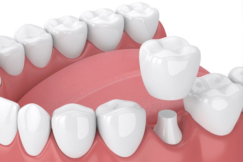 Dental Crowns in El Dorado Hills