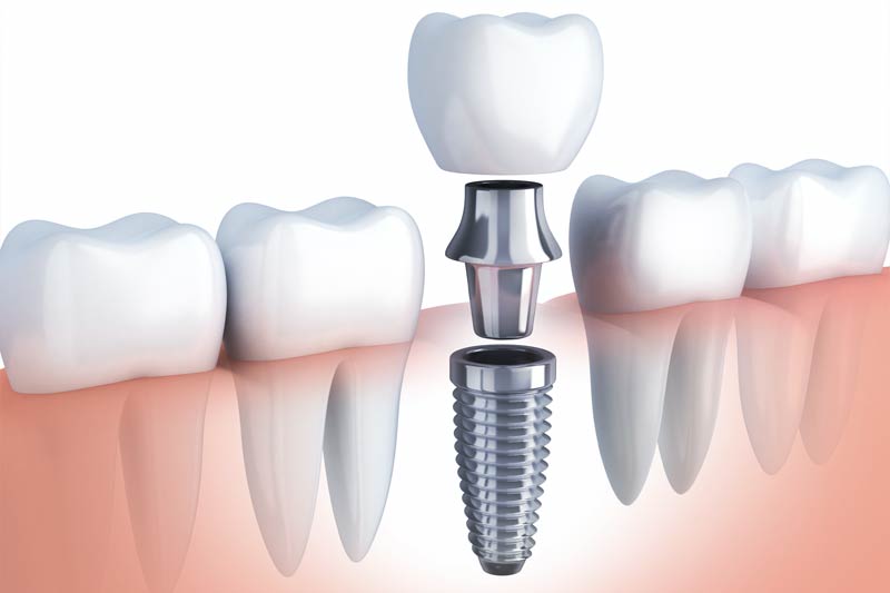 Implants Dentist in El Dorado Hills