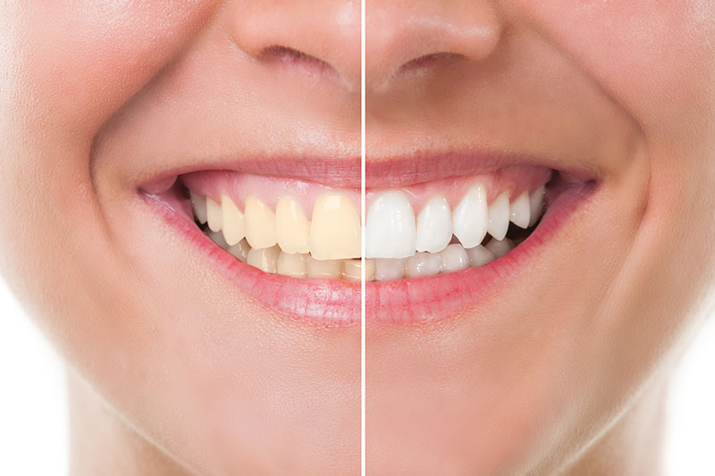 Teeth Whitening in El Dorado Hills