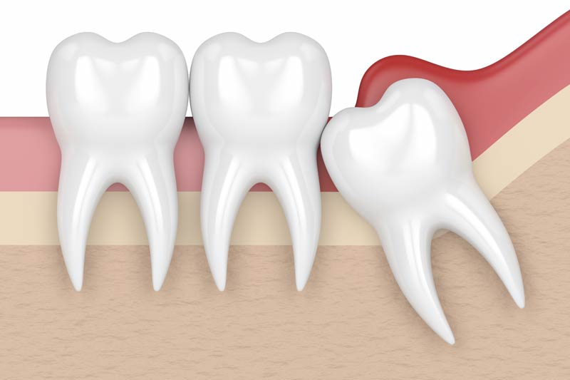 Wisdom Tooth Removal in El Dorado Hills